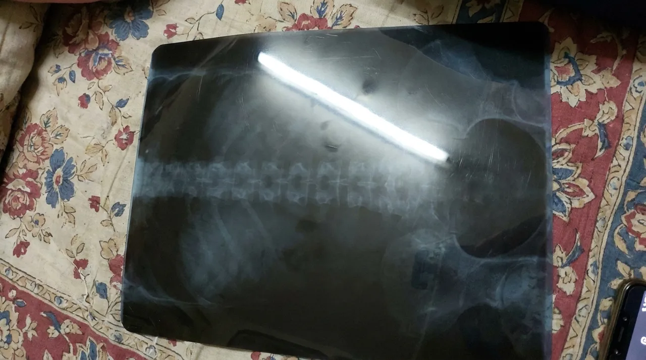 बिस्तर की चादर पर रखी X-ray फ़िल्म की अँधेरी फ़ोटो, जिस पर ट्यूबलाइट की चमक पड़ रही है